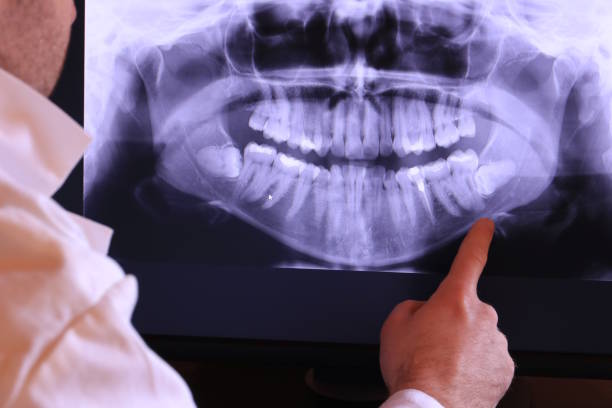 Best Knocked-Out Tooth (Avulsed Tooth) Treatment in Echelon, NJ